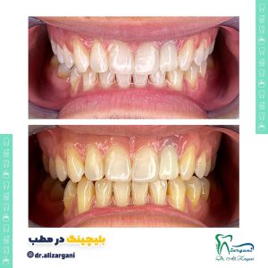 بلیچینگ در مطب دکتر علی زرگانی دندانپزشک زیبایی فرمانیه تهران