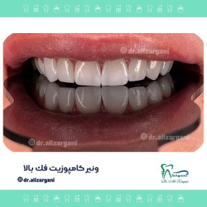دندانپزشک خوب ونیر کامپوزیت در تهران