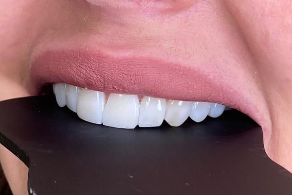 نمونه کار دکتر علی زرگانی | دندانپزشک زیبایی تهران