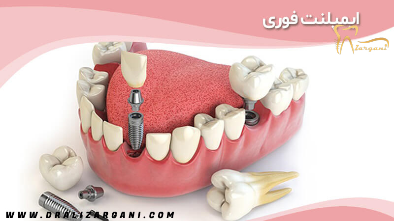 دندانپزشک در شمال تهران | دکتر لمینت در تهران