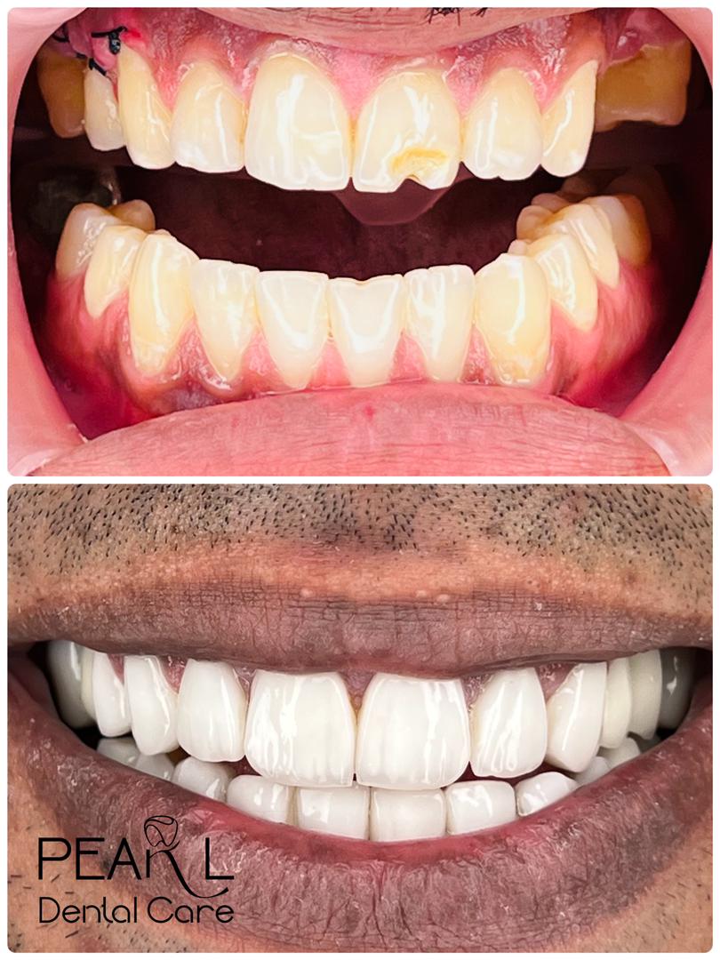 نمونه کار دکتر علی زرگانی | دندانپزشک زیبایی فرمانیه